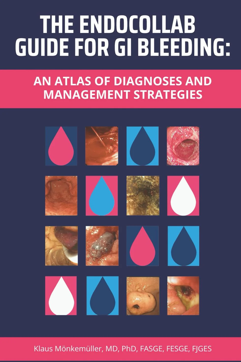 The EndoCollab Guide for GI Bleeding: An Atlas of Diagnoses and Management Strategies